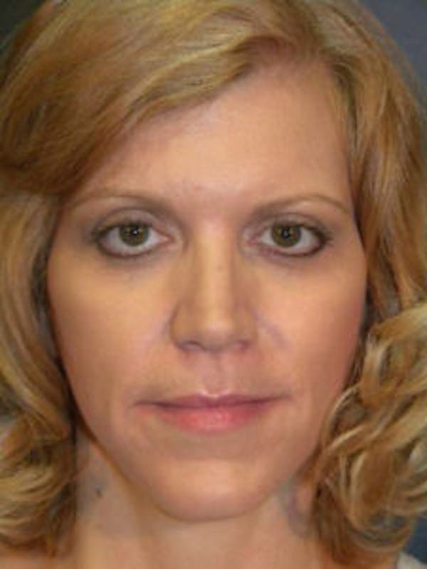 Face Lift Before & After Gallery - Patient 4595215 - Image 4