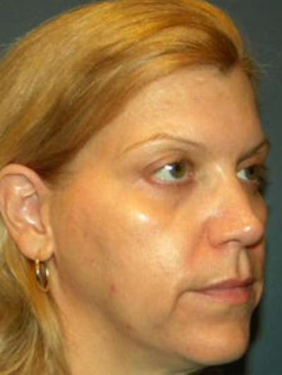 Face Lift Before & After Gallery - Patient 4595215 - Image 1