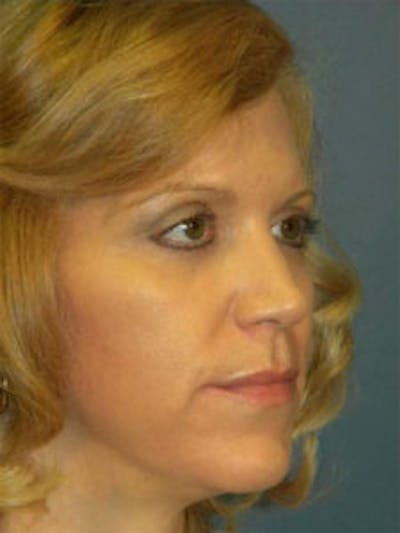 Face Lift Before & After Gallery - Patient 4595215 - Image 2