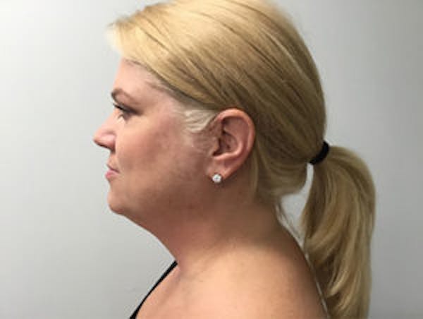 Kybella® Before & After Gallery - Patient 4595280 - Image 1