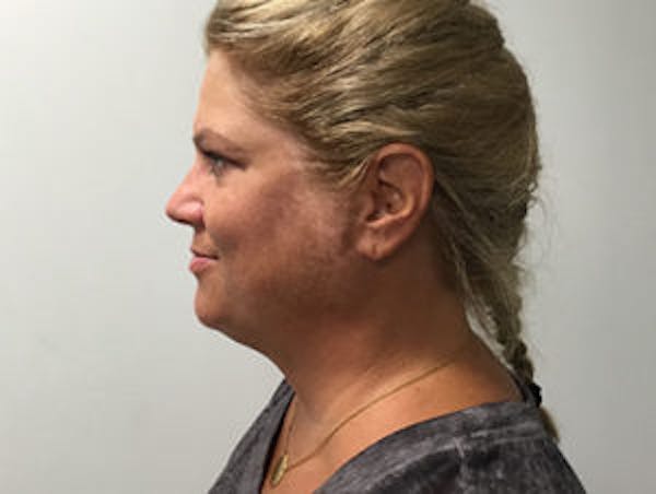 Kybella® Before & After Gallery - Patient 4595280 - Image 2