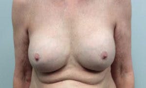 Breast Implant Removal