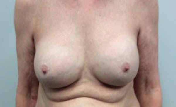 Breast Implant Removal and Replacement Gallery - Patient 4598836 - Image 1