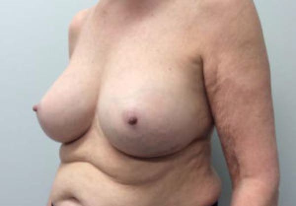 Breast Implant Removal and Replacement Before & After Gallery - Patient 4598836 - Image 4
