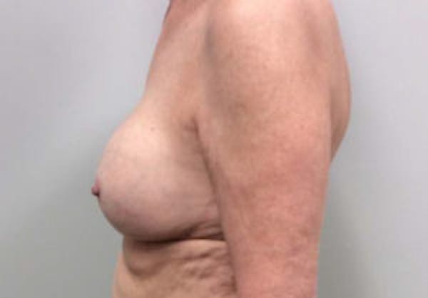 Breast Implant Removal and Replacement Before & After Gallery - Patient 4598836 - Image 5