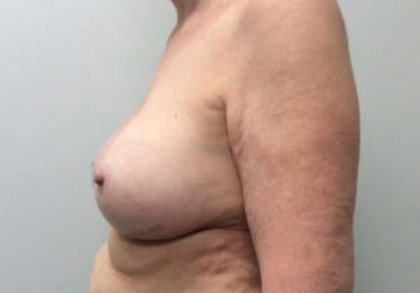 Breast Implant Removal and Replacement Before & After Gallery - Patient 4598836 - Image 6