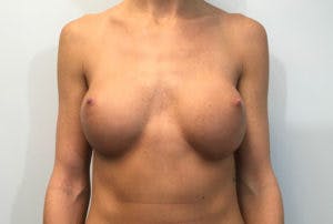 Breast Implant Removal