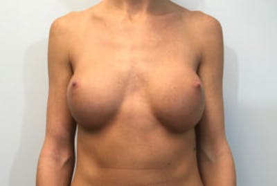 Breast Implant Removal and Replacement Before & After Gallery - Patient 4598848 - Image 1