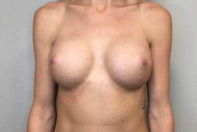 Breast Implant Removal and Replacement Before & After Gallery - Patient 4598848 - Image 2