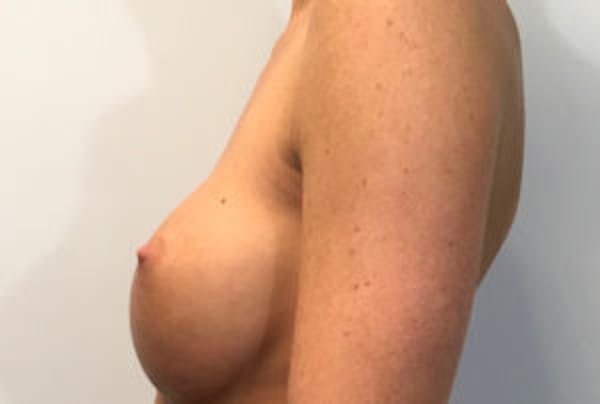 Breast Implant Removal and Replacement Before & After Gallery - Patient 4598848 - Image 3