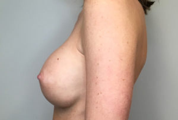 Breast Implant Removal and Replacement Before & After Gallery - Patient 4598848 - Image 4