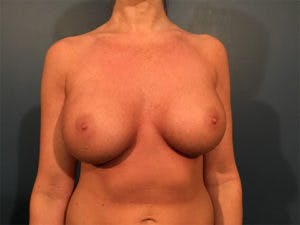 Breast Implant Removal