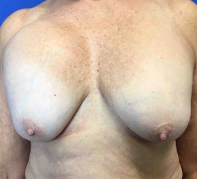 Breast Implant Removal and Replacement Before & After Gallery - Patient 4598867 - Image 1