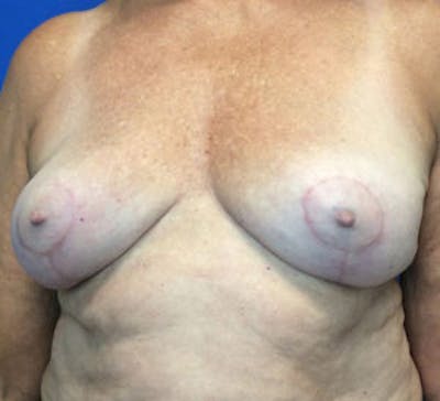 Breast Implant Removal and Replacement Before & After Gallery - Patient 4598867 - Image 2