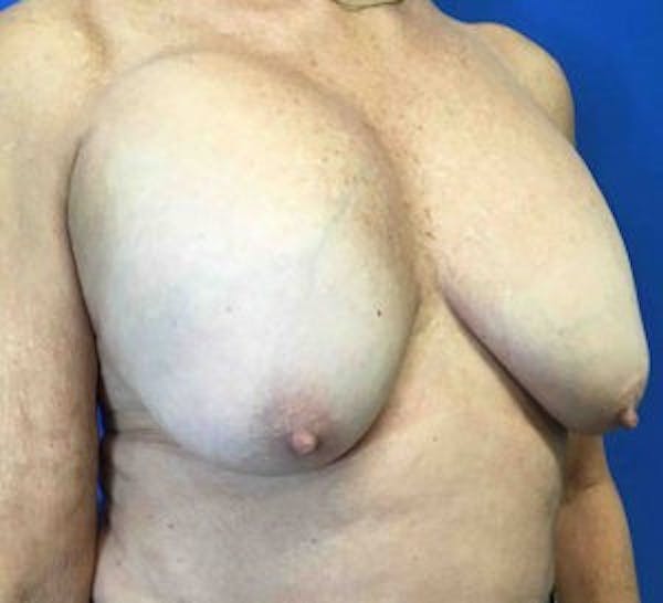Breast Implant Removal and Replacement Before & After Gallery - Patient 4598867 - Image 3