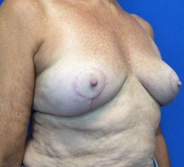 Breast Implant Removal and Replacement Before & After Gallery - Patient 4598867 - Image 4