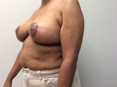 Breast Reduction Before & After Gallery - Patient 4594953 - Image 4