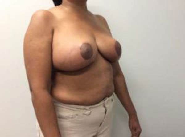 Breast Reduction Gallery - Patient 4594953 - Image 8
