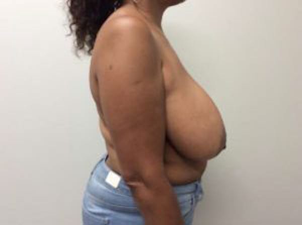 Breast Reduction Before & After Gallery - Patient 4594953 - Image 9