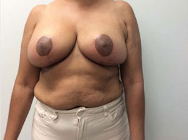 Breast Reduction Before & After Gallery - Patient 4594953 - Image 2