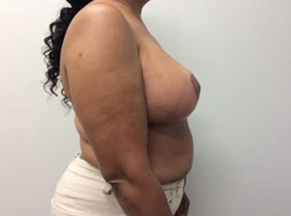 Breast Reduction Before & After Gallery - Patient 4594953 - Image 10