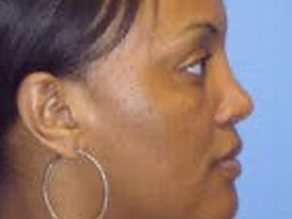 Rhinoplasty Before & After Gallery - Patient 4595135 - Image 2
