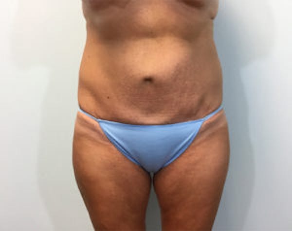 Non-Invasive Body Contouring Before & After Gallery - Patient 4710163 - Image 1