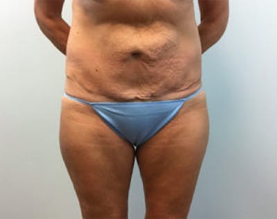 Non-Invasive Body Contouring Before & After Photos