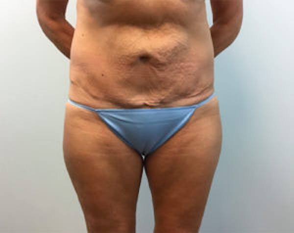 Non-Invasive Body Contouring Before & After Gallery - Patient 4710163 - Image 2