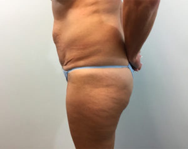 Non-Invasive Body Contouring Before & After Gallery - Patient 4710163 - Image 3