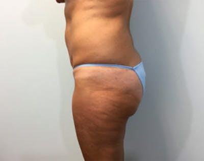 Non-Invasive Body Contouring Before & After Gallery - Patient 4710163 - Image 4
