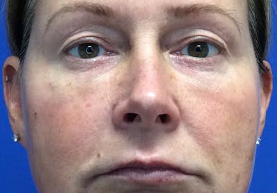 Blepharoplasty Before & After Gallery - Patient 4595101 - Image 1