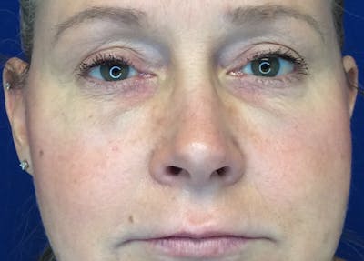 Blepharoplasty Before & After Gallery - Patient 4595101 - Image 2