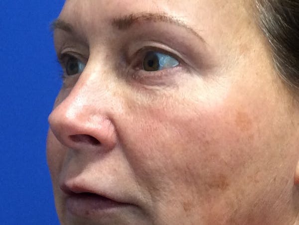 Blepharoplasty Before & After Gallery - Patient 4595101 - Image 3