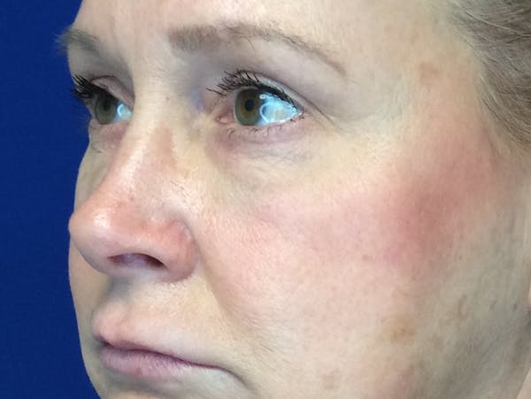 Blepharoplasty Before & After Gallery - Patient 4595101 - Image 4