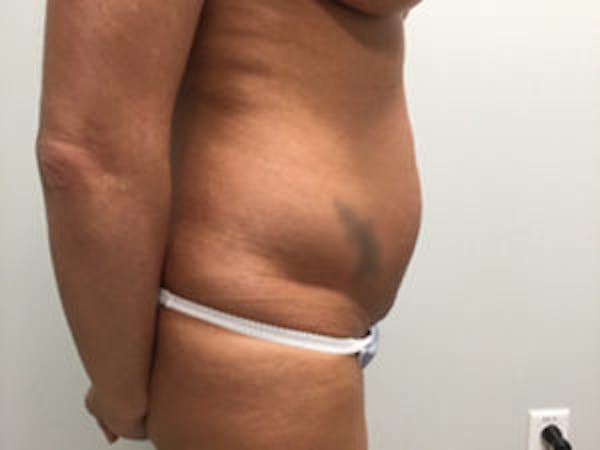 Liposuction Before & After Gallery - Patient 4726802 - Image 3