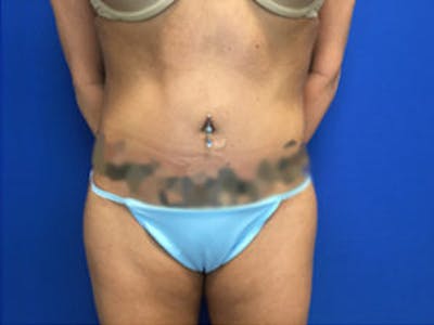 Liposuction Before & After Gallery - Patient 4726802 - Image 2