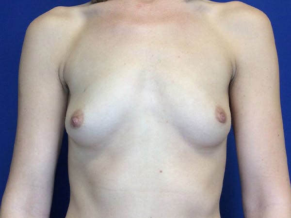 Breast Augmentation Before & After Gallery - Patient 4868530 - Image 1