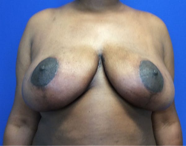Breast Reduction Gallery - Patient 4890903 - Image 2