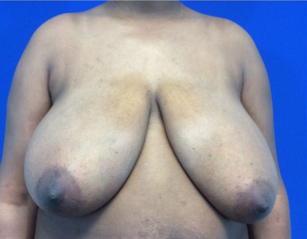 Breast Reduction Before & After Gallery - Patient 4890903 - Image 1