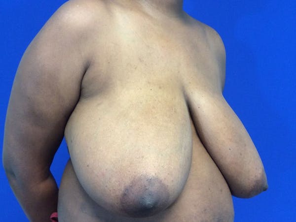 Breast Reduction Before & After Gallery - Patient 4890903 - Image 3