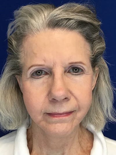 Face Lift Before & After Gallery - Patient 4891393 - Image 4