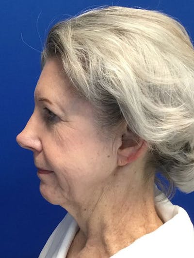 Face Lift Before & After Gallery - Patient 4891393 - Image 1