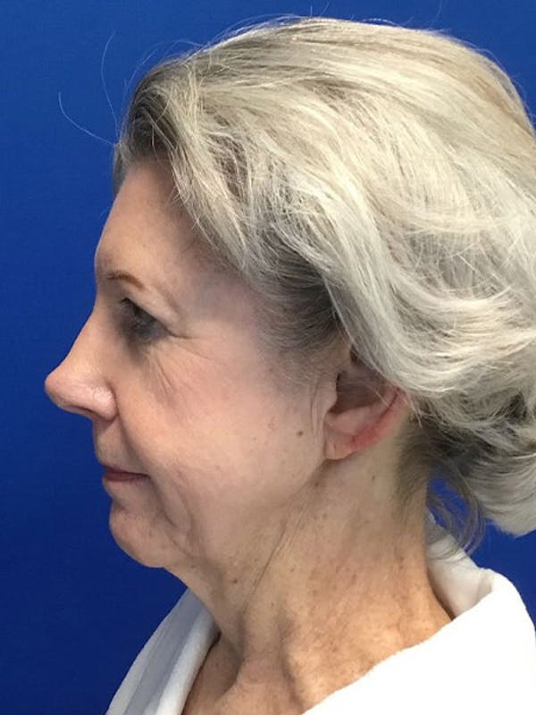Neck Lift Before & After Gallery - Patient 4891400 - Image 3