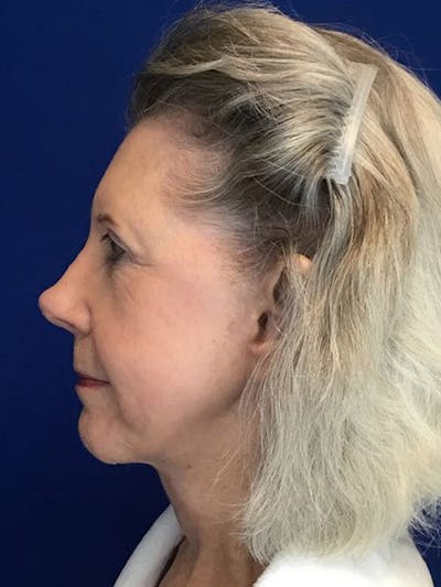 Face Lift Before & After Gallery - Patient 4891393 - Image 2