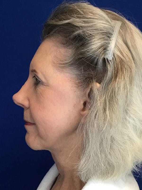 Neck Lift Before & After Gallery - Patient 4891400 - Image 4