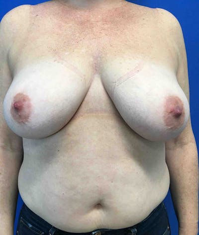 Mastopexy Before & After Gallery - Patient 4910306 - Image 1