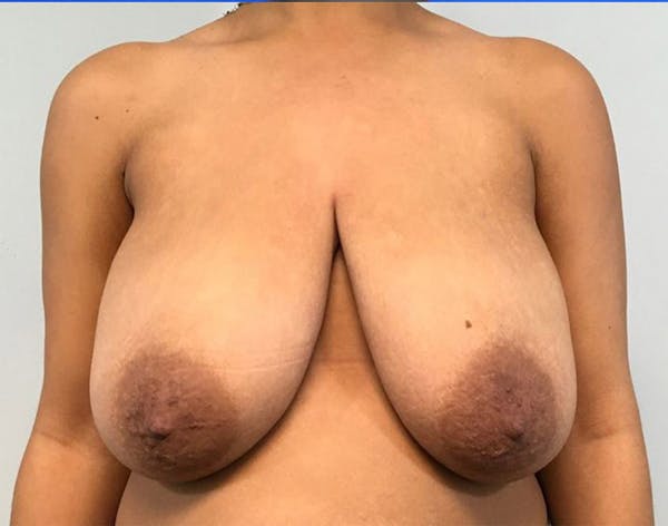 Breast Reduction Before & After Gallery - Patient 4930554 - Image 1
