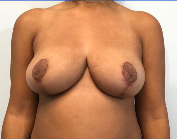 Breast Reduction Before & After Gallery - Patient 4930554 - Image 2