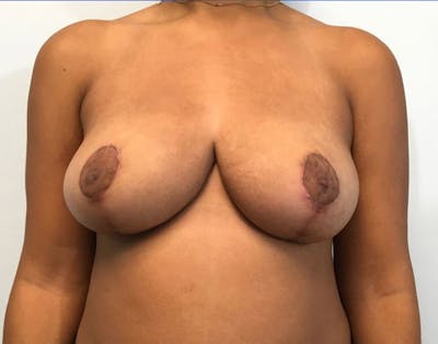 Breast Reduction Before & After Gallery - Patient 4930554 - Image 2